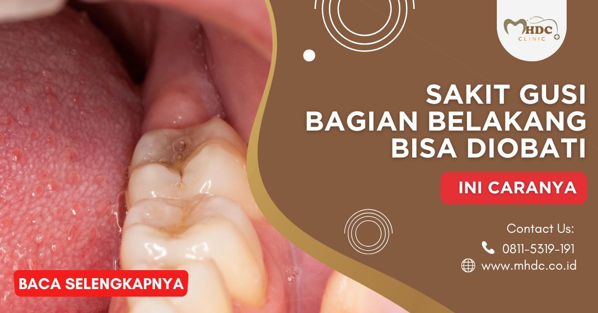 Sakit Gusi Bagian Belakang Bisa Diobati