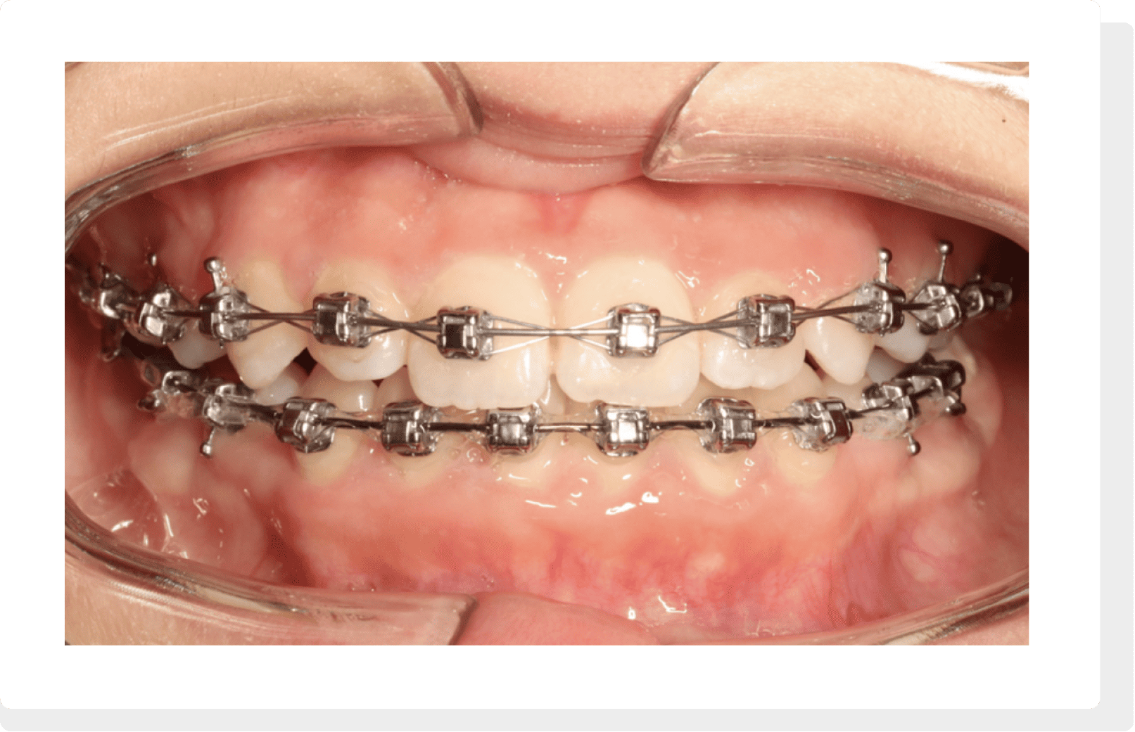 Self Ligating Brace