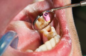 Perawatan sakit gigi berlubang hingga akar
