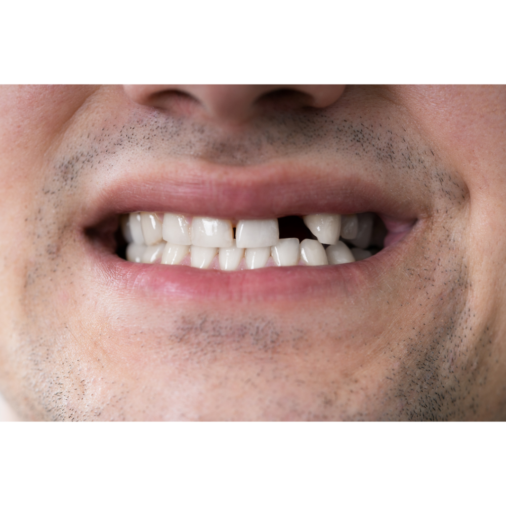 Pentingnya Pasang Gigi Palsu Untuk Gigi yang Hilang