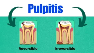 Pulpitis reversible dan irreversible