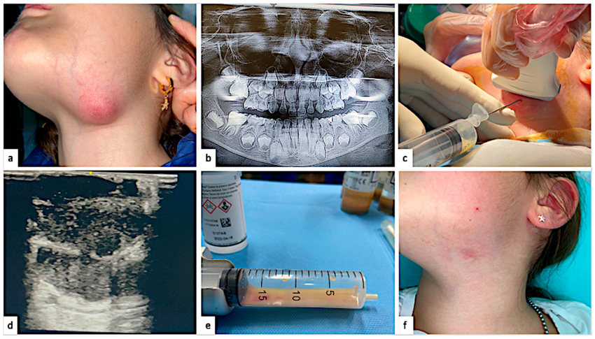 abses submandibular adalah