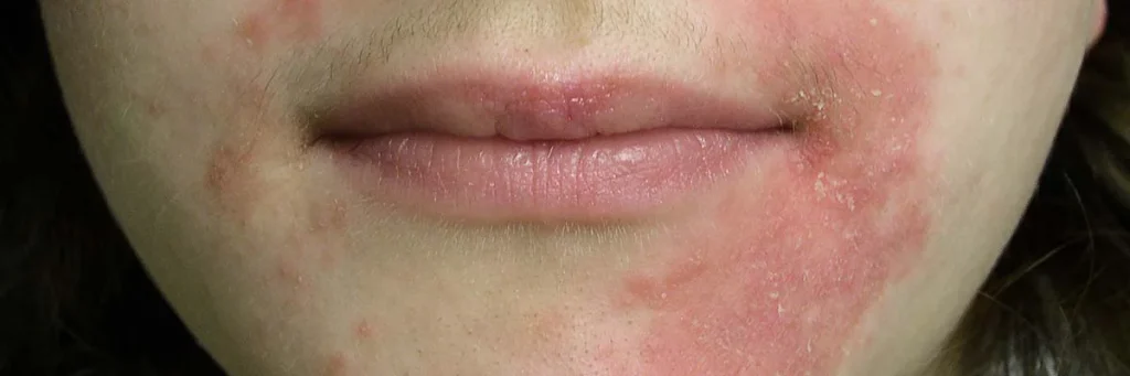 Perioral dermatitis