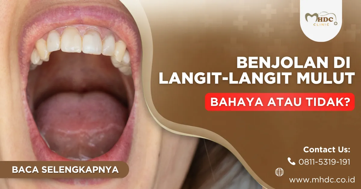 benjolan di langit-langit mulut, bahayakah?