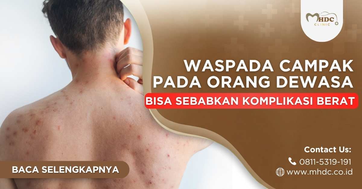 campak pada orang dewasa