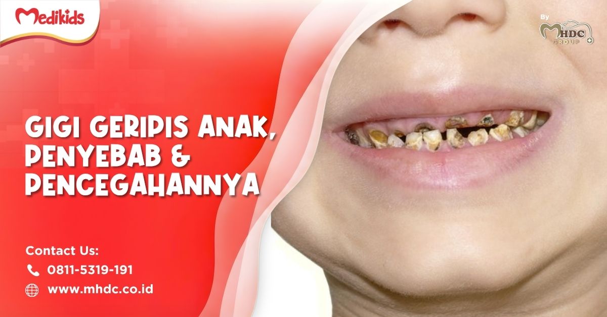 gigi geripis anak adalah kondisi kerusakan gigi dengan tanda beberapa gigi si kecil yang menghitam