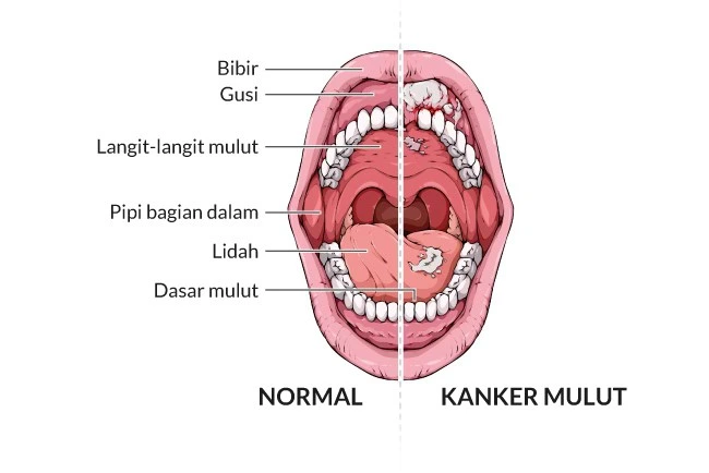 Ilustrasi kanker mulut dan normal