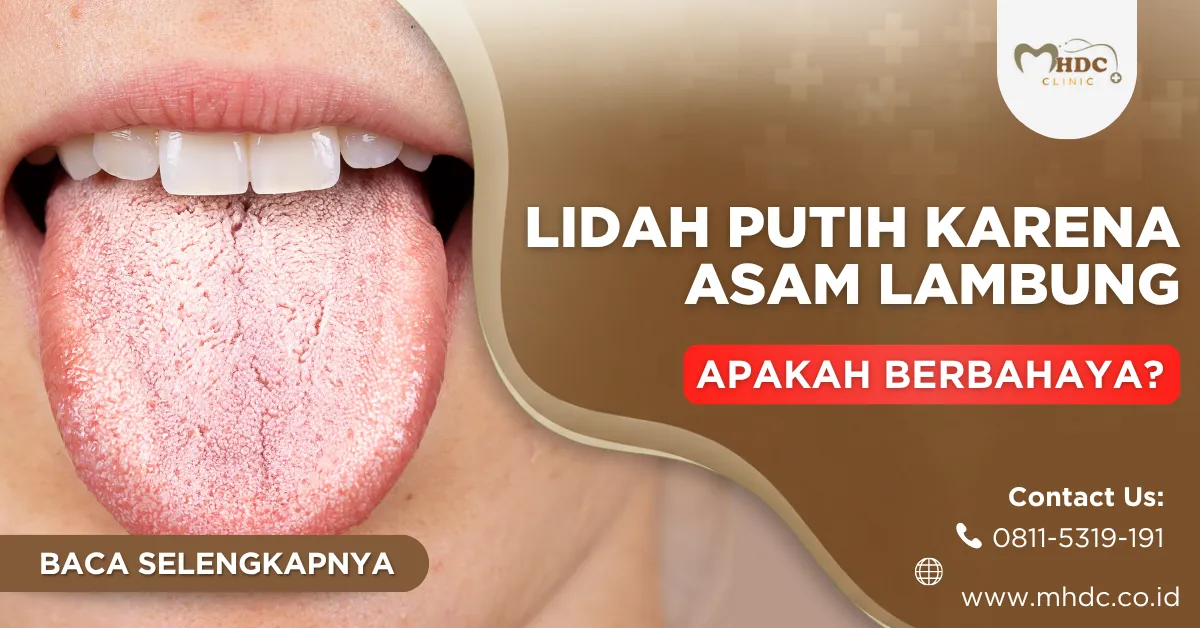lidah putih karena asam lambung