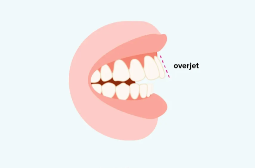 overjet
