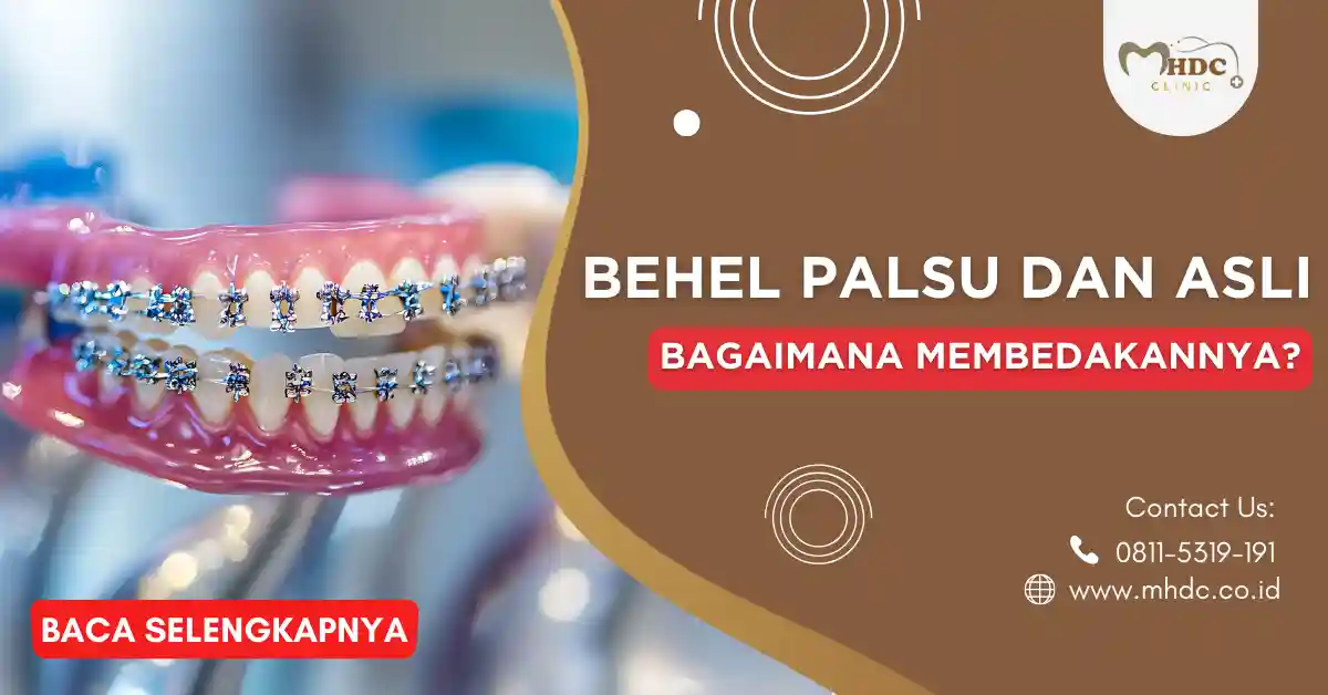 behel palsu