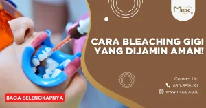 bleaching gigi harga