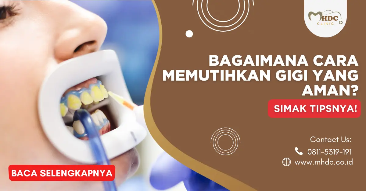 bagaimana cara memutihkan gigi