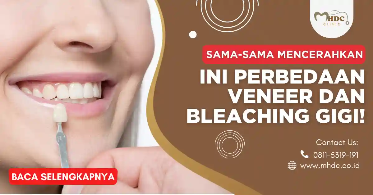 perbedaan veneer dan bleaching gigi