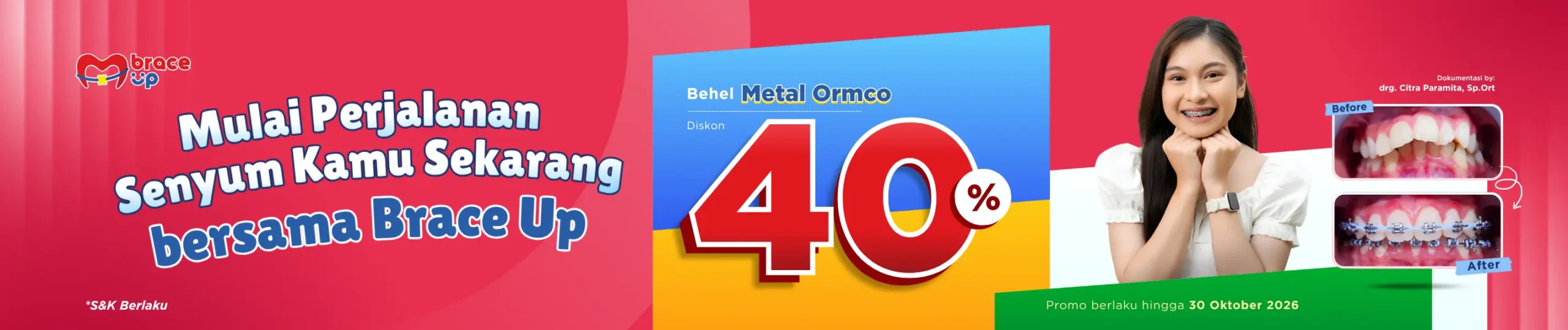promo pasang behel medikids - brace up by medikids