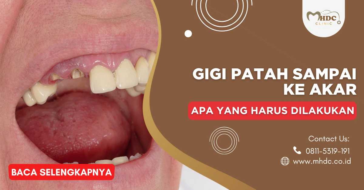 gigi patah sampai akar