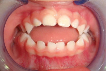 gigi rusak akibat dot