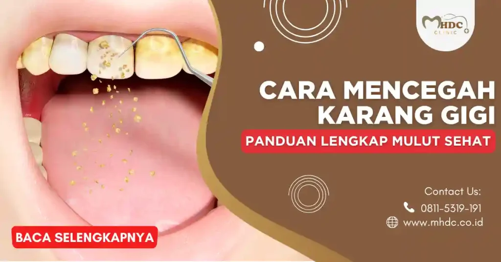 penyebab karang gigi