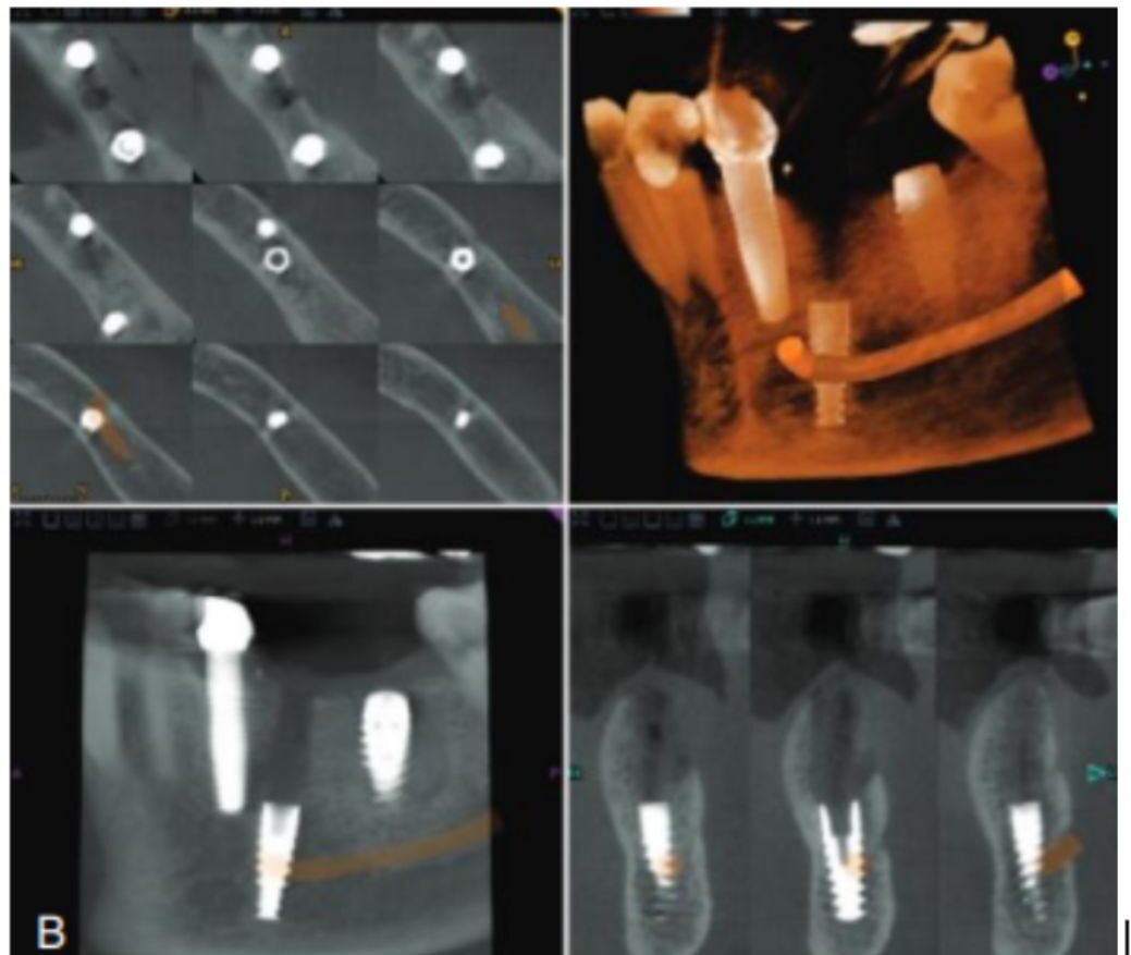 rontgen CBCT sebelum implan