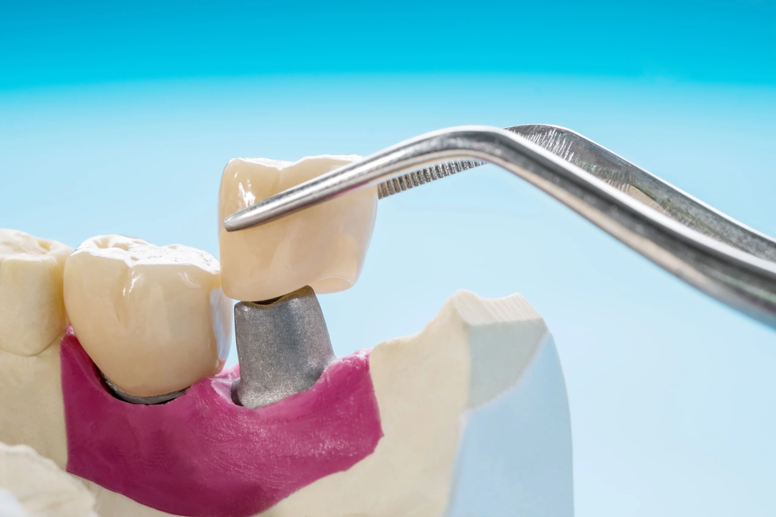 Pemasangan crown Dental crown setelah perawatan saluran akar (PSA)