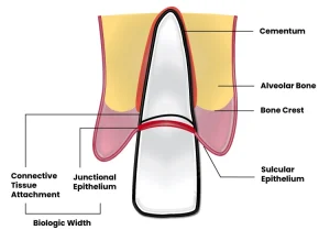 crown lengthening