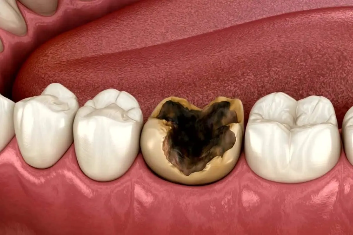 gigi berlubang bau mulut