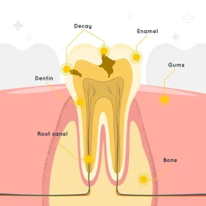 ilustrasi gigi berlubang