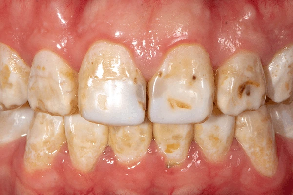 Fluorosis gigi