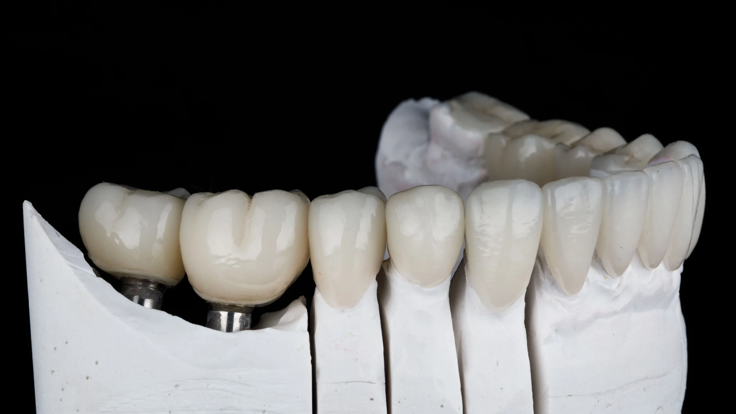 Crown gigiDental crown