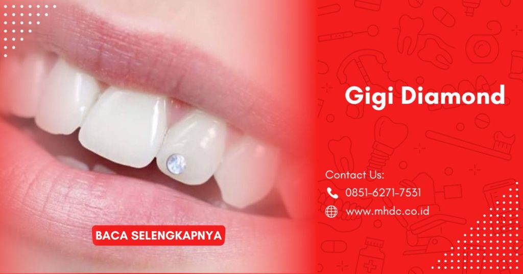 Mengenal Diamond Gigi & Proses Pemasangannya