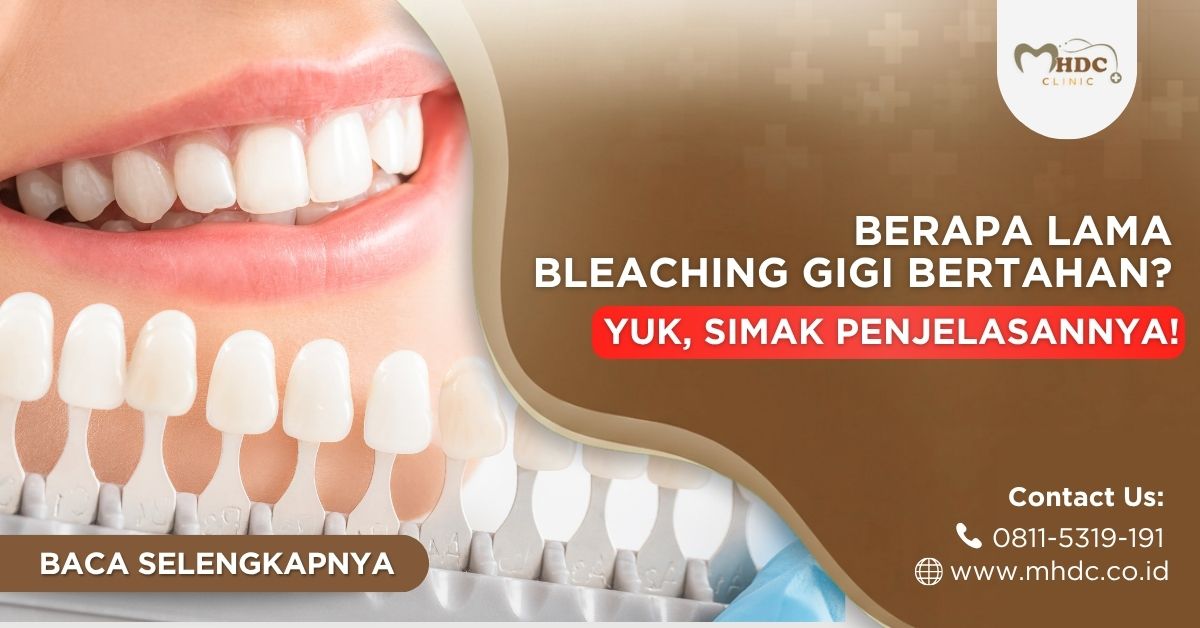berapa lama bleaching gigi bertahan? klinik bleaching gigi