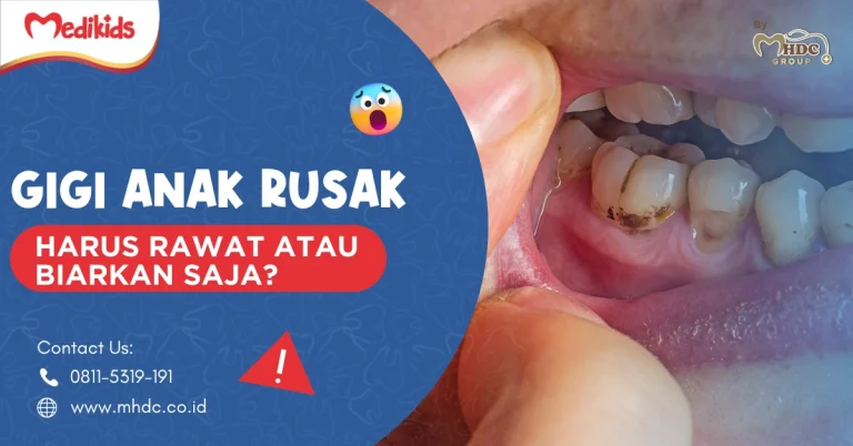 Gigi Anak Rusak, Harus Rawat atau Biarkan Saja?