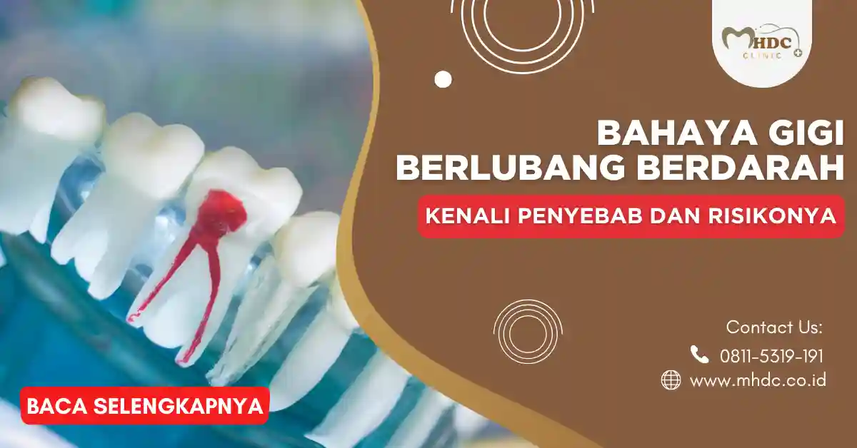 gigi berlubang berdarah