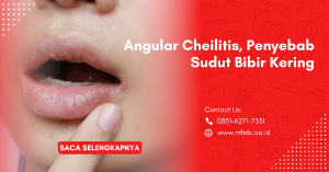 angular cheilitis