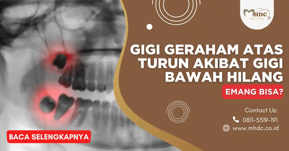 gigi geraham atas turun