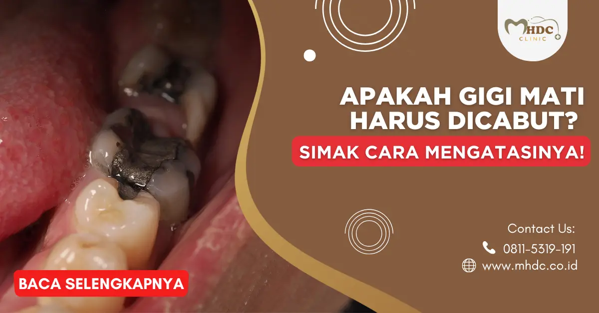 syaraf gigi mati