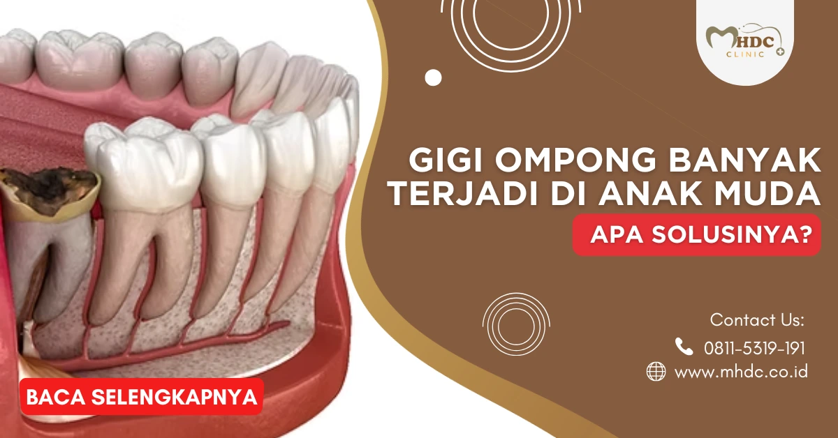 solusi gigi ompong anak muda