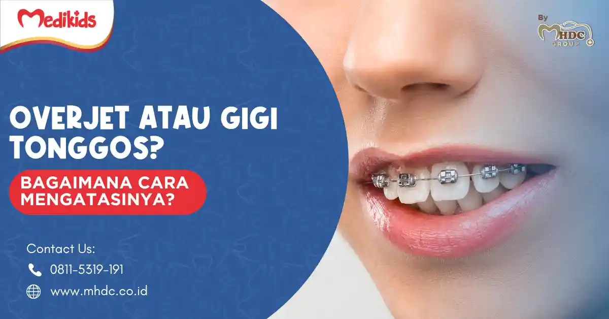 overjet adalah
