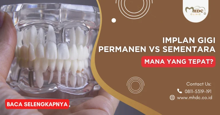Implan Gigi Permanen vs Sementara, Mana yang Tepat?