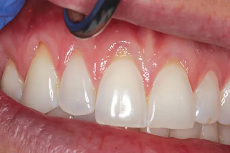 Resesi gingiva