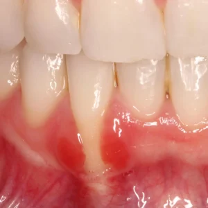 gum graft adalah