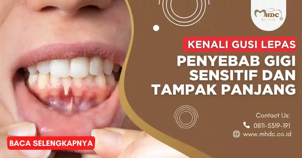 gusi lepas