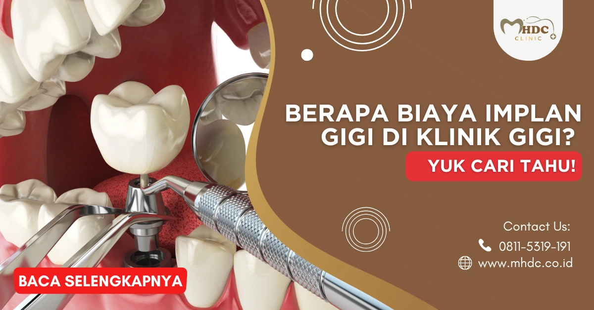 harga implan gigi
