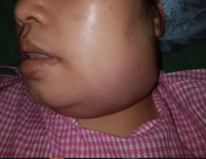 abses submandibula adalah