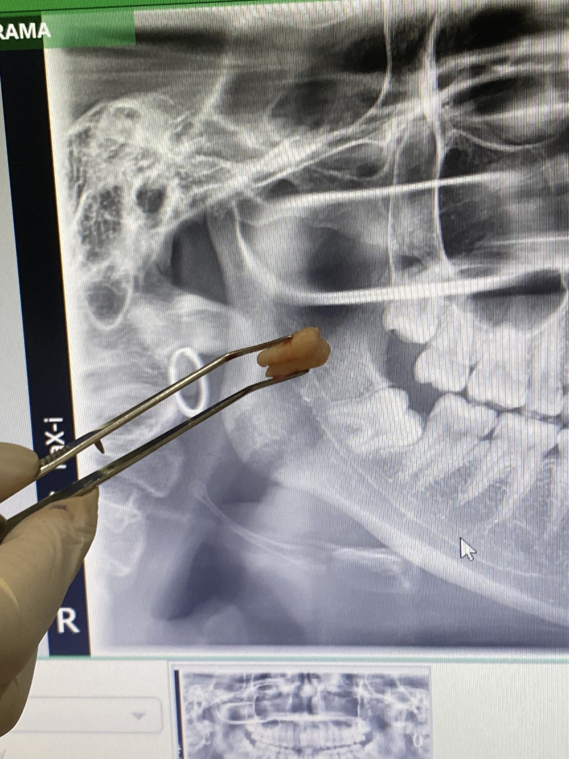 Hasil rontgen gigi bungsu yang tumbuh miring terpendam