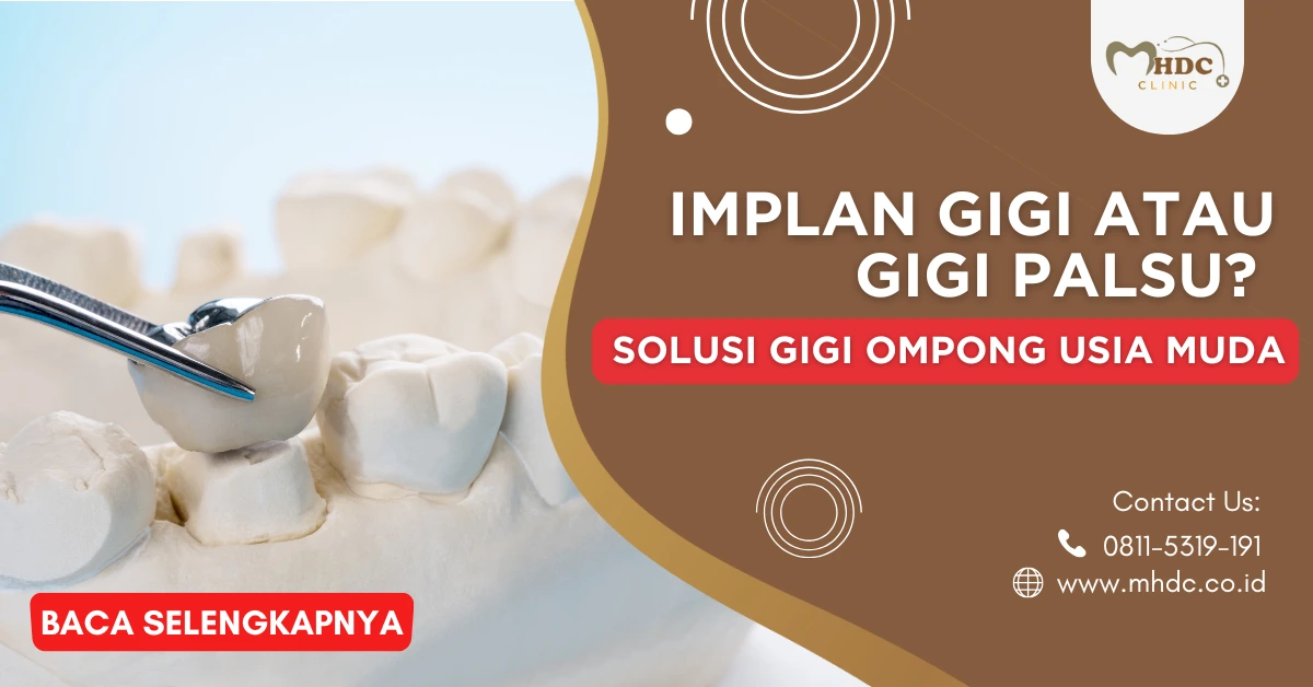 pasang implan gigi