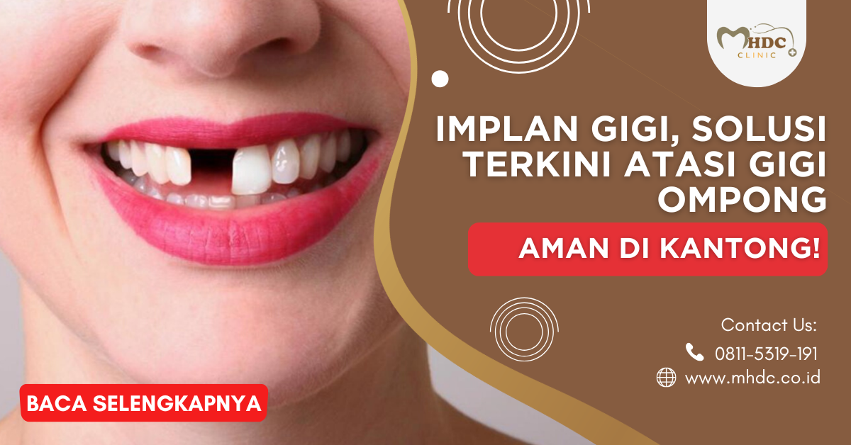 implan gigi