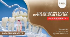 gigi berdenyut karena infeksi saluran akar gigi