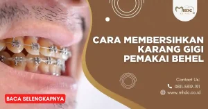 karang gigi pemakai behel