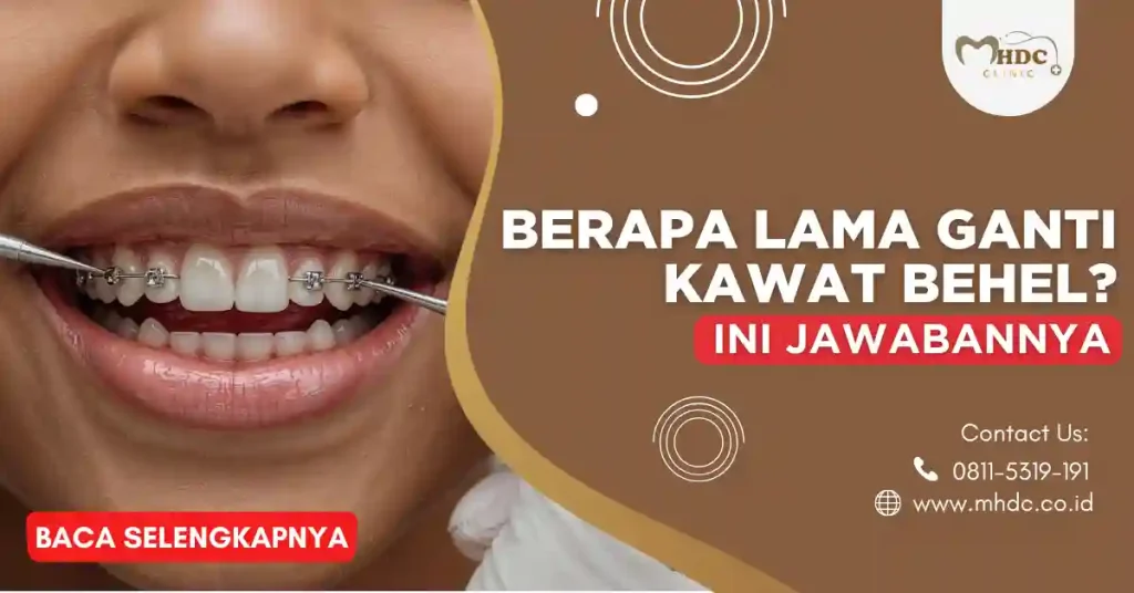 berapa lama ganti kawat behel