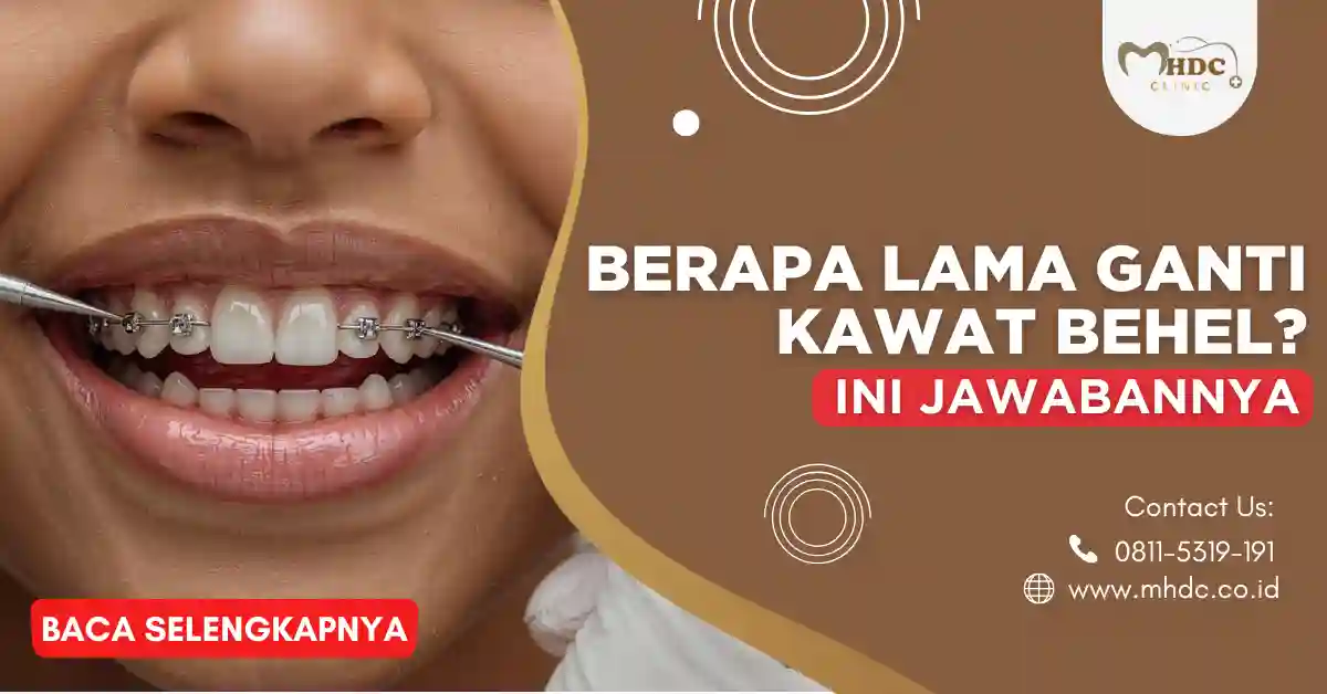 berapa lama ganti kawat behel